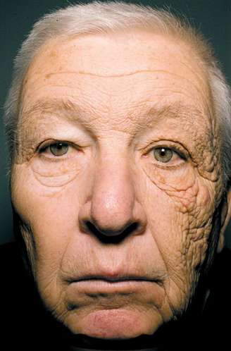 Caminhoneiro tem um lado do rosto "machucado" pela exposição ao sol enquanto dirige